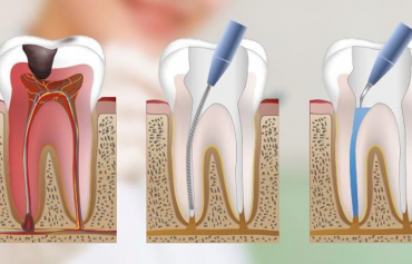 Root canals