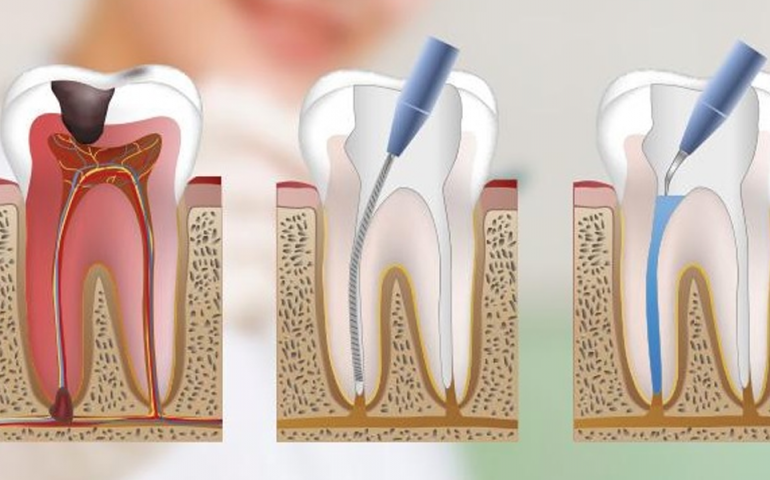 Root canals