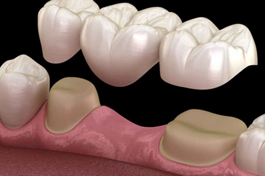 Crown & Bridge restorations