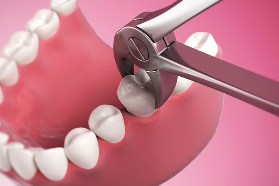 Teeth Extraction