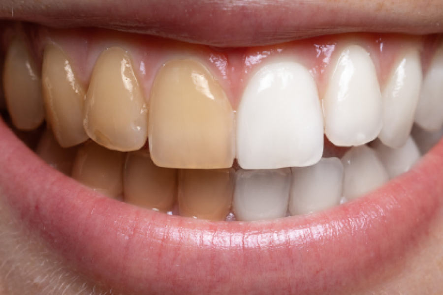 Teeth whitening is a valuable investment in your self-esteem