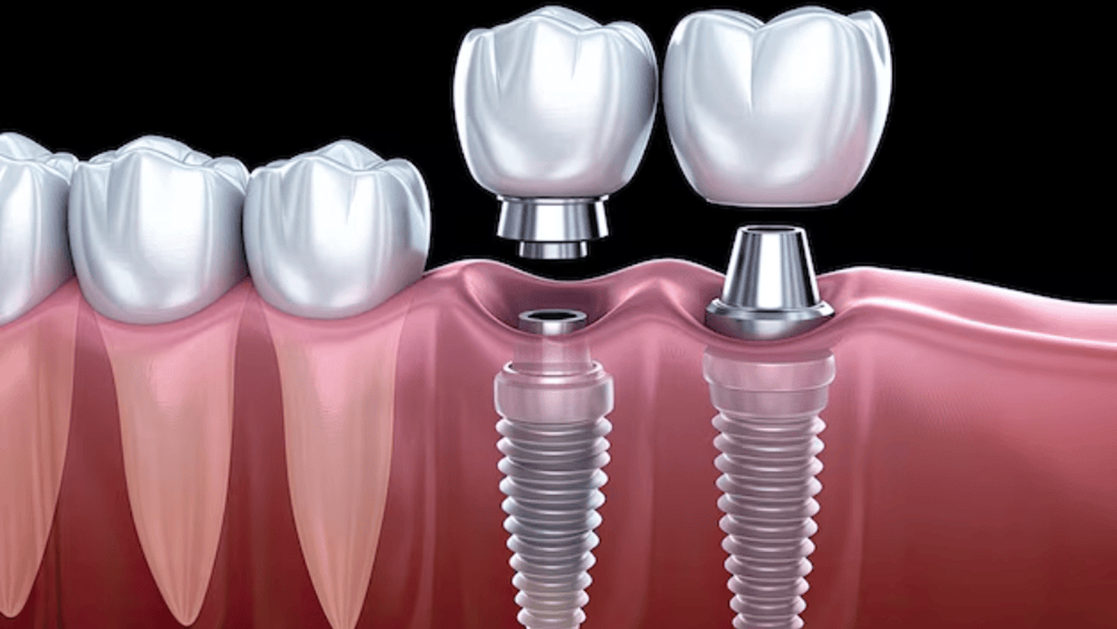 Dental Implants