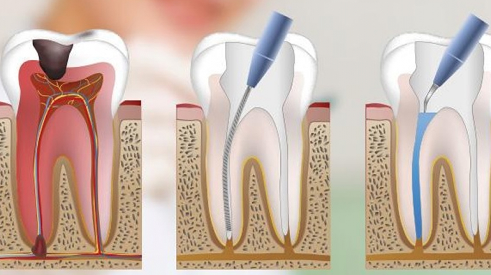 Root canals